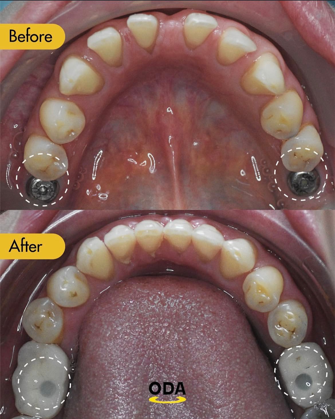 Perawatan gigi implan, veneer & clear aligner di Oda Dental Clinic Jakarta Utara