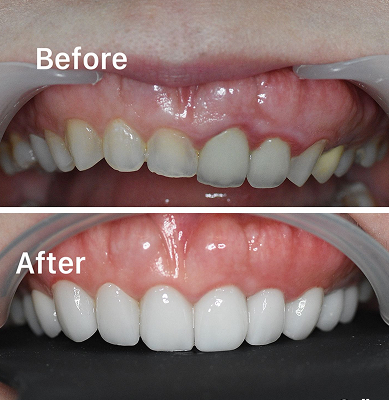 Perawatan gigi implan, veneer & clear aligner di Oda Dental Clinic Jakarta Utara