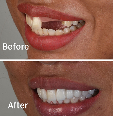 Perawatan gigi implan, veneer & clear aligner di Oda Dental Clinic Jakarta Utara