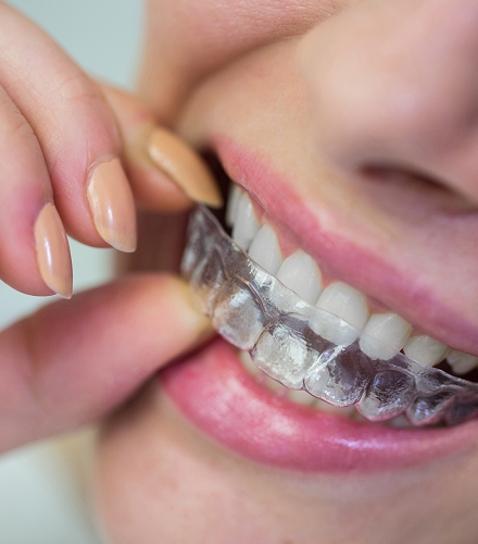 Pasien menggunakan clear aligner transparan di Oda Dental Clinic