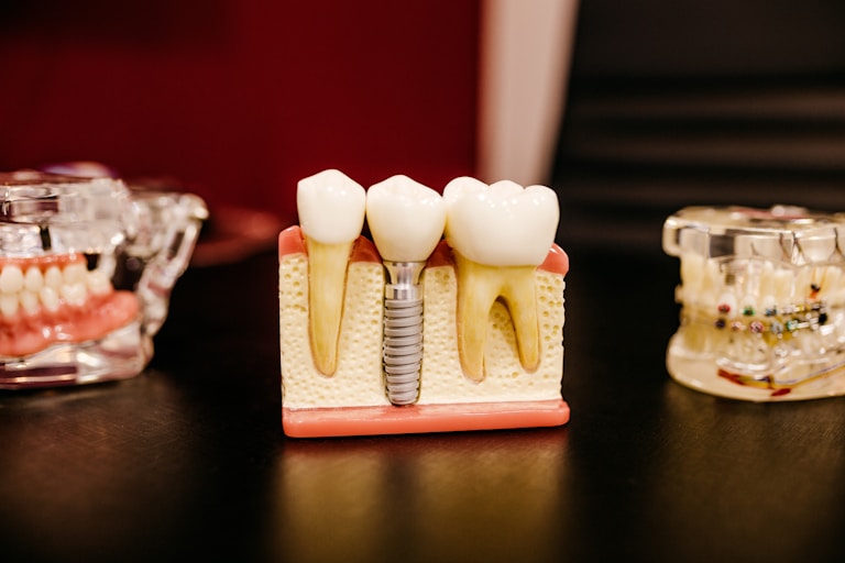 Perawatan gigi implan, veneer & clear aligner di Oda Dental Clinic Jakarta Utara