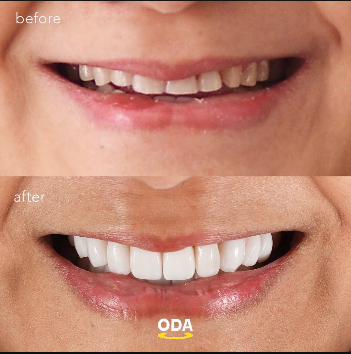 Perawatan gigi implan, veneer & clear aligner di Oda Dental Clinic Jakarta Utara
