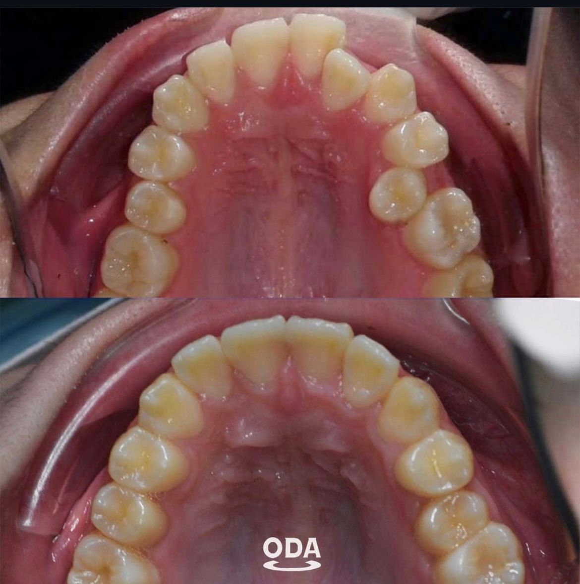 Perawatan gigi implan, veneer & clear aligner di Oda Dental Clinic Jakarta Utara
