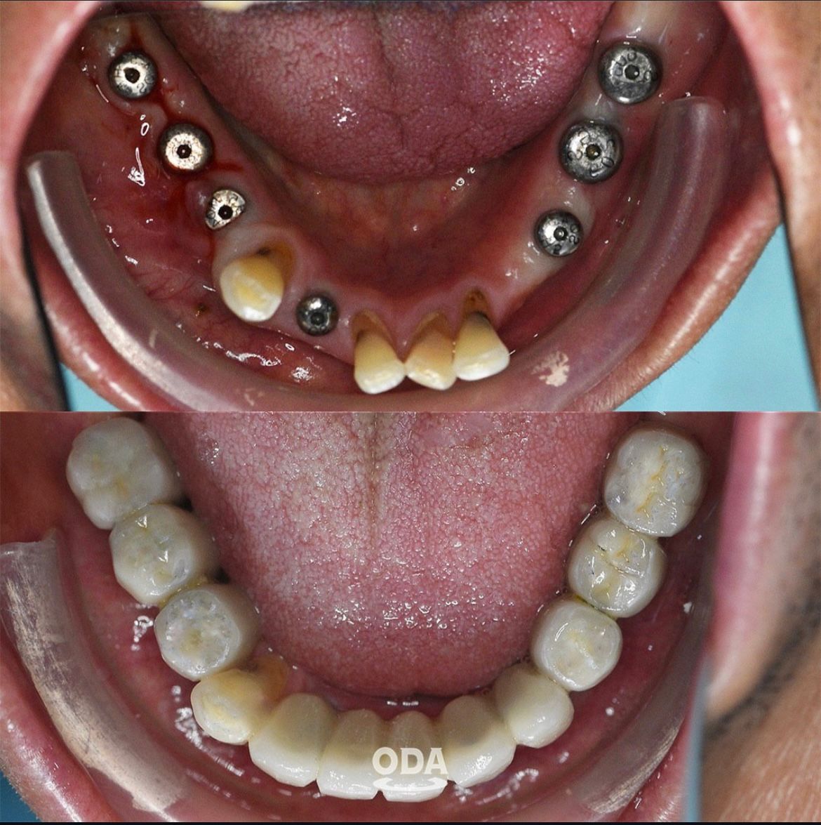 Perawatan gigi implan, veneer & clear aligner di Oda Dental Clinic Jakarta Utara