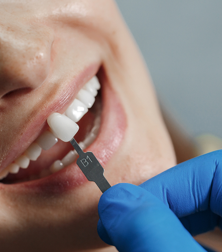Hasil veneer gigi estetik di Oda Dental Clinic Jakarta Utara