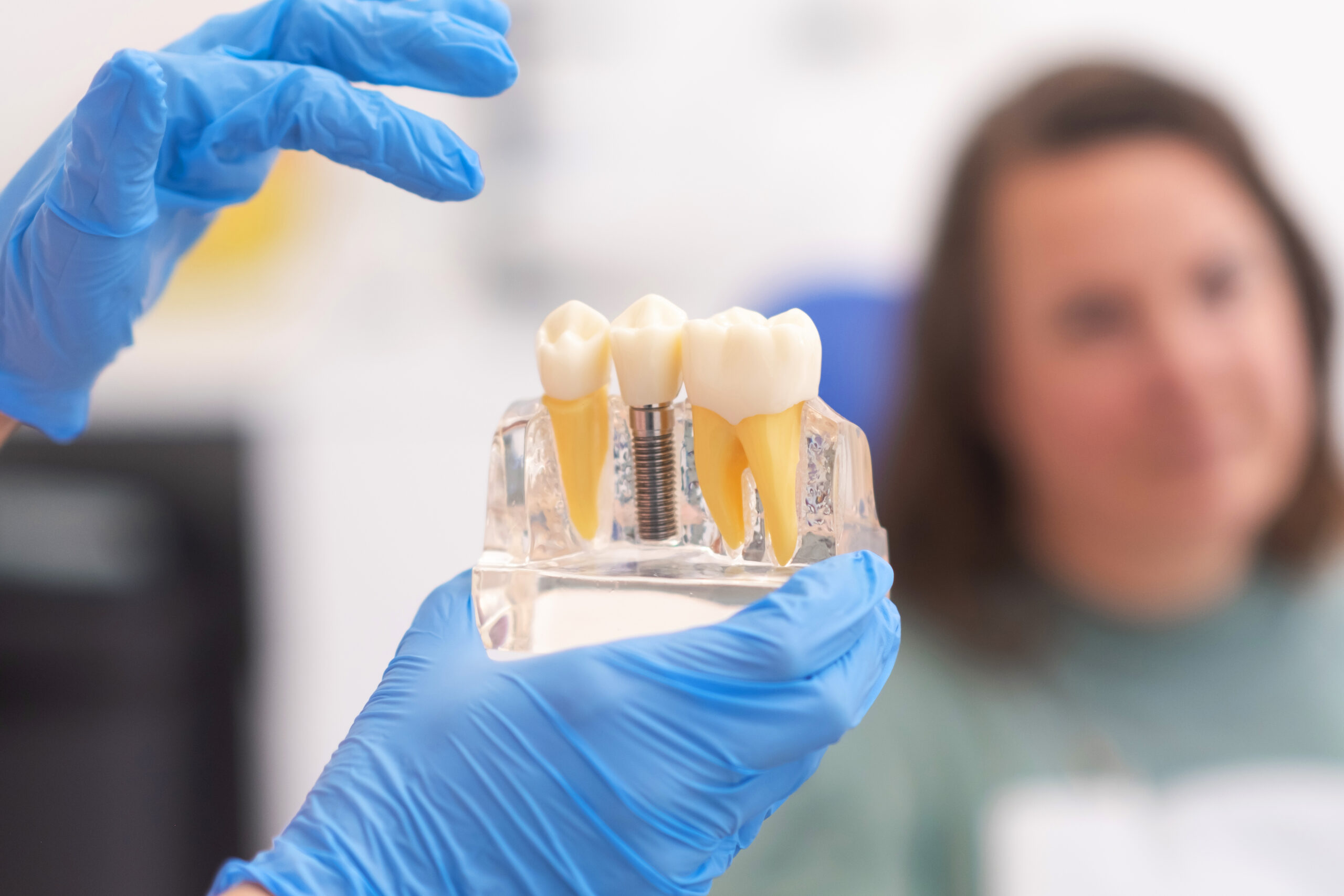 Prosedur implan gigi digital tanpa operasi besar di Oda Dental Clinic