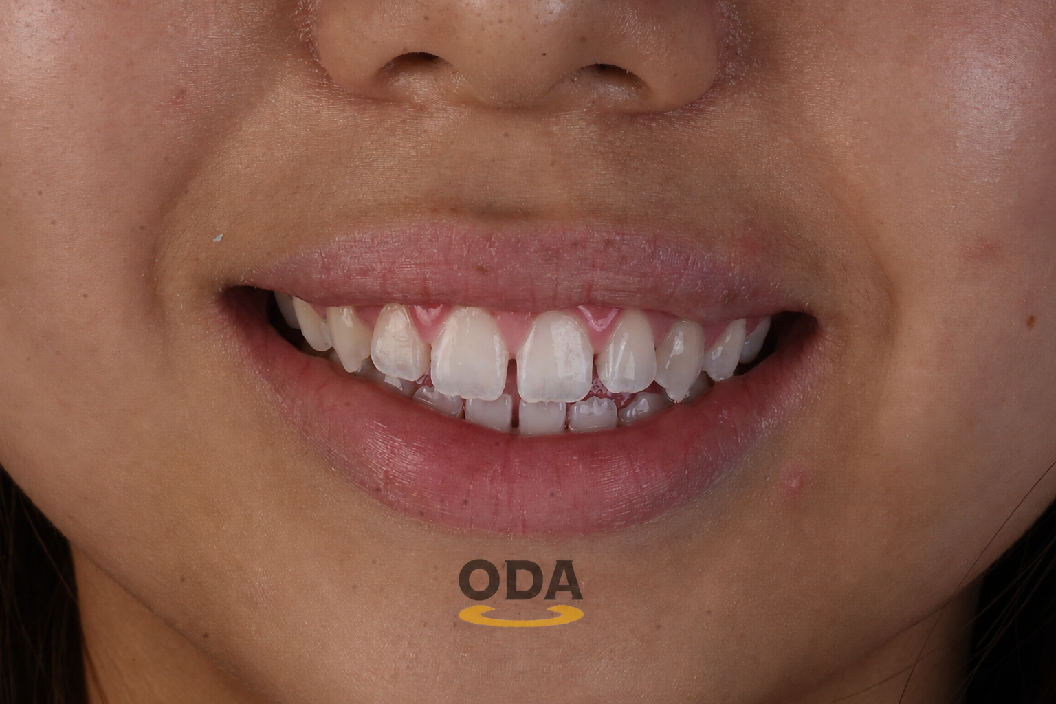 Oda Dental Clinic Jakarta Utara - Implan Gigi, Veneer & Clear Aligner