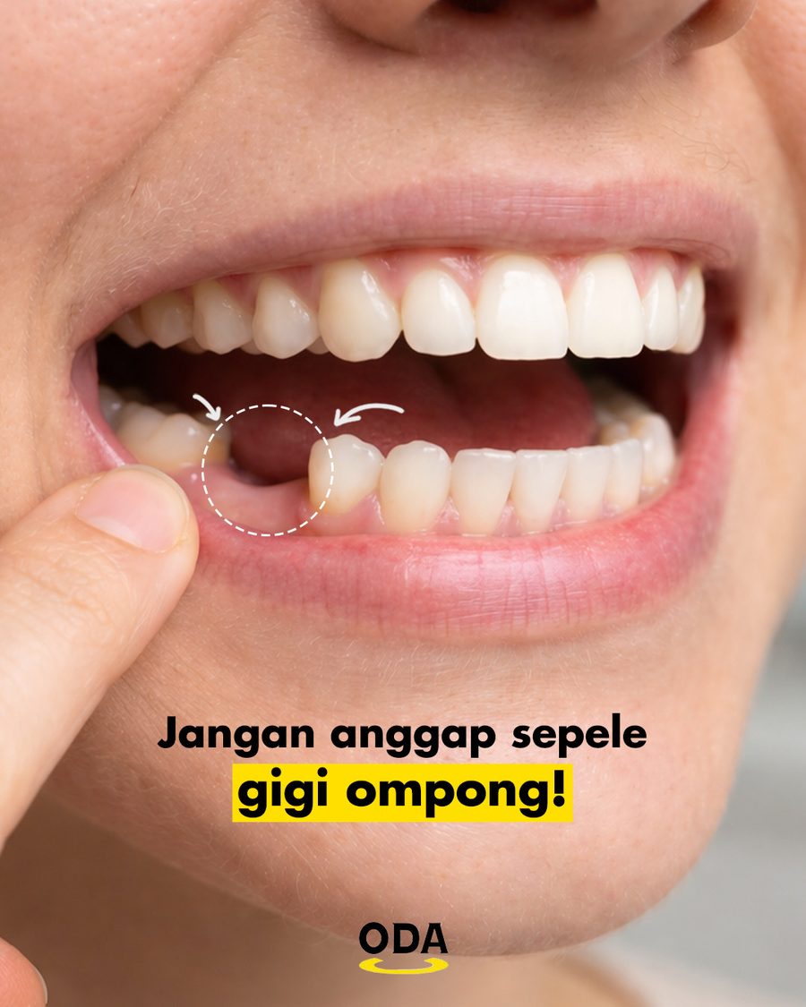 Jangan anggap sepele gigi ompong - risiko gigi hilang