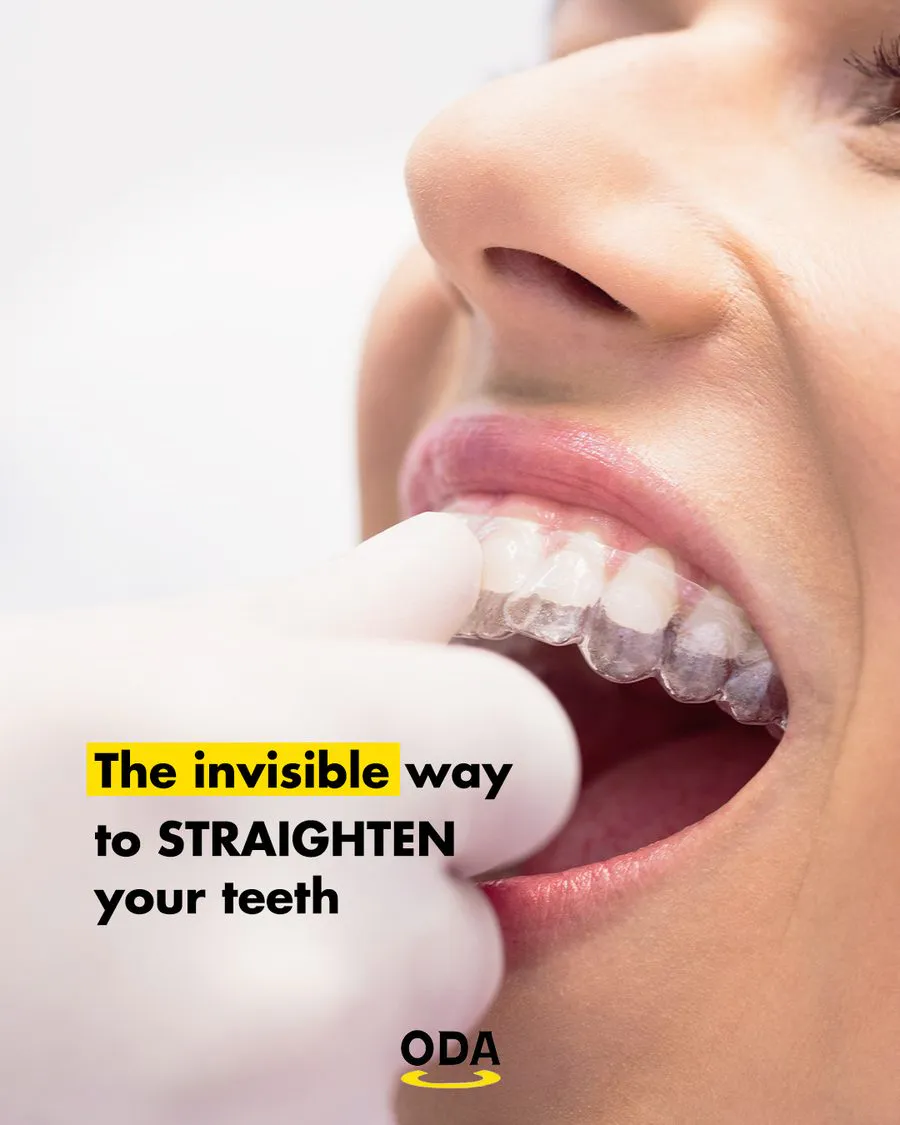 Clear aligner transparan untuk merapikan gigi tanpa kawat besi
