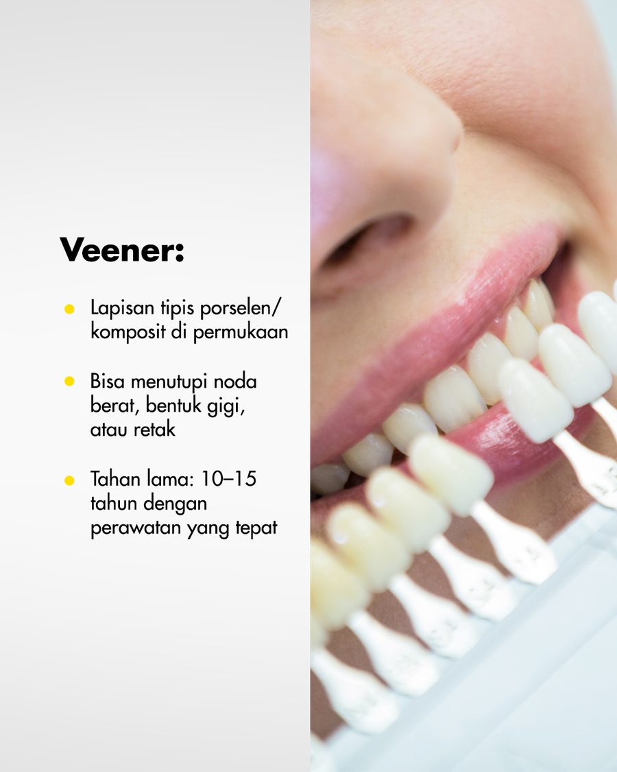 Informasi veneer gigi porselen di Oda Dental Clinic