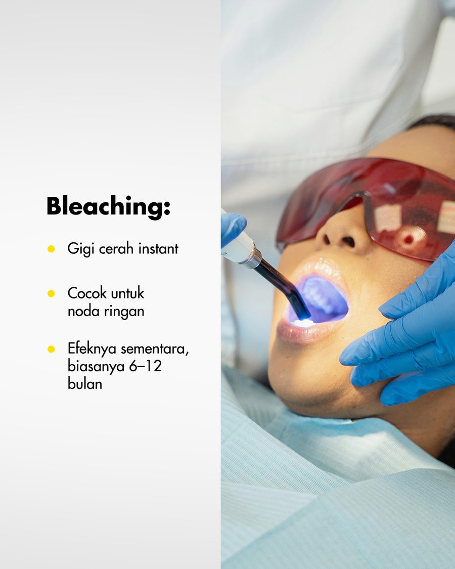 Informasi bleaching pemutihan gigi di Oda Dental Clinic