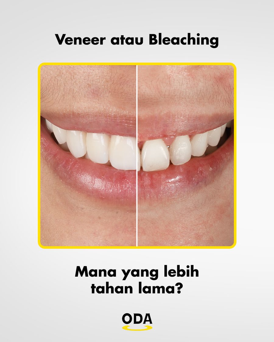 Veneer atau bleaching - perbandingan hasil gigi putih