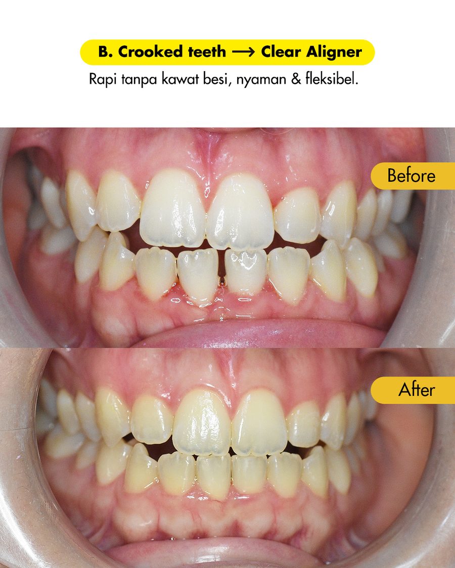 Hasil clear aligner sebelum dan sesudah - gigi rapi tanpa kawat