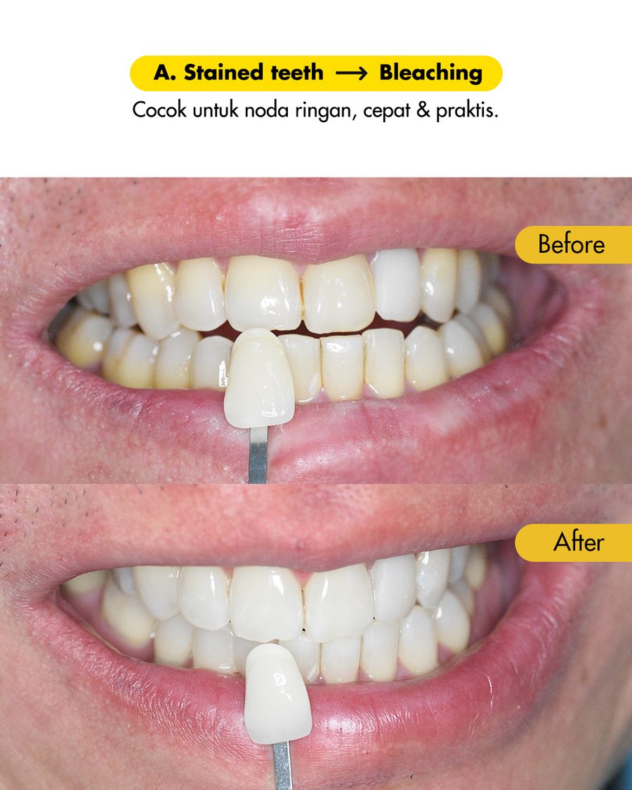 Hasil bleaching gigi sebelum dan sesudah di Oda Dental Clinic