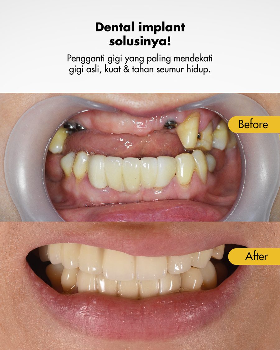 Hasil implan gigi sebelum dan sesudah di Oda Dental Clinic